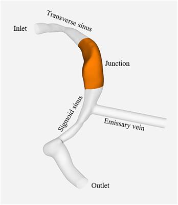 Effect of Emissary Vein on Hemodynamics of the Transverse- Sigmoid Sinus Junction